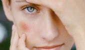 Couperose viso: rimedi migliori sintomi cause, come curarla