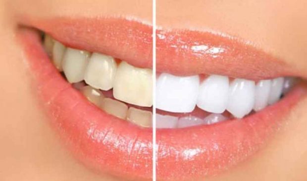 Sbiancamento denti: dentista prezzo 2020 seduta laser costo fai da te