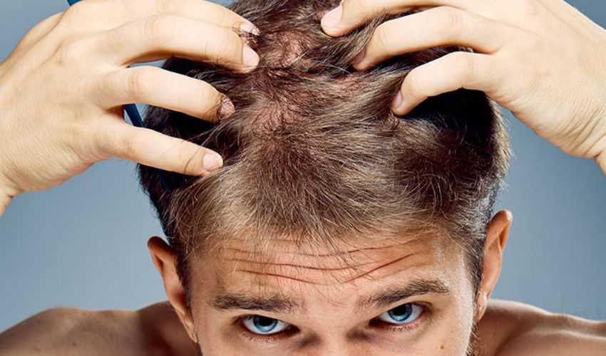 prevenire la caduta dei capelli in modo naturale